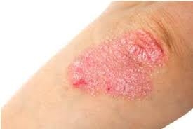 Psoriasis Treatment Cream: Finding the Best Solutions in Riyadh