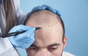 Why Hair Loss Treatment in Dubai is the Preferred Choice for Fuller, Healthier Hair