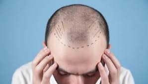 How to Choose the Perfect Hair Transplant Clinic in Riyadh