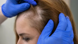 Managing Alopecia Areata with Modern Treatments in Dubai