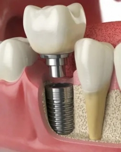 How Much Do Dental Implants Cost in Dubai? A Detailed Breakdown