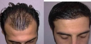 Hair Transplant Packages in Dubai: Are They Really a Better Deal?