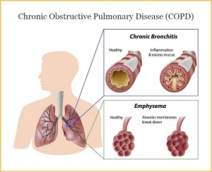 COPD and Smoking: How Quitting Can Change the Course of the Disease