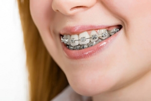 Choose braces for healthier teeth