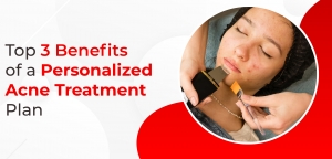 Top 3 Benefits of a Personalized Acne Treatment Plan