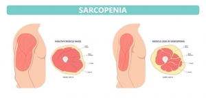 Sarcopenia Treatment Market is anticipated to Witness High Growth Owing to Increasing