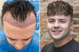 Is a Hair Transplant in Riyadh Right for You? A Detailed Guide