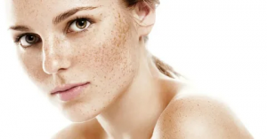 Advanced Freckles and Blemishes Treatment in Dubai