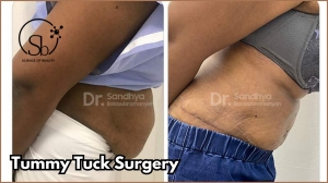 Who Are the Ideal Candidates for Tummy Tuck?