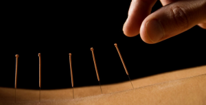 Acupuncture in Washington DC: Natural Solutions for Better Health