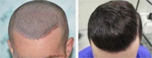 Why Dubai is the Go-To Destination for Hair Transplant Procedures