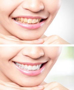 Transform Your Smile with Hollywood Smile Design in Riyadh