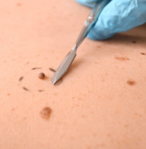 Quick and Easy Skin Tag Removal Treatment: What Works and What Doesn’t