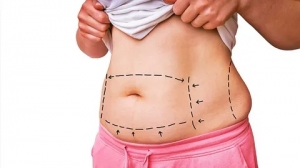 The Benefits of Choosing Liposuction Surgery in Dubai