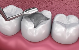 The Cost of Dental Fillings in Riyadh: A Breakdown for Patients