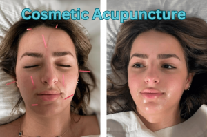 The Benefits of Frankincense and Acupuncture: A Holistic Approach