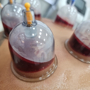 The Financial Implications of Choosing Hijama Treatment in Dubai