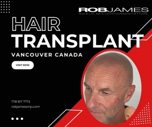 Understanding Hair Transplant Cost: What You Need to Know