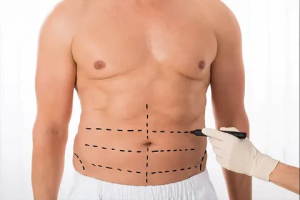 The Future of Liposuction: Innovations on the Horizon