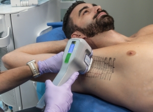 Transform Your Skin: The Power of Miradri Treatment Revealed