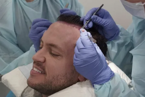 The Latest Innovations in Hair Transplantation Technology in Abu Dhabi