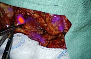 Fluorescence Guided Surgery System Market Size, Share, Forecast Report | 2024 to 2032 | Reports and Insights