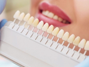 Brighten Your Smile: The Ultimate Guide to Teeth Whitening in St Albans