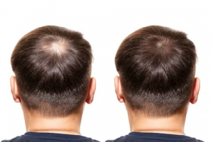 Exploring Non-Surgical Hair Restoration Alternatives in Abu Dhabi