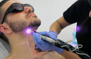 Exploring the Cost of Laser Hair Removal in Abu Dhabi