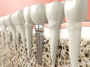 Can I get dental implants at the age of 18?