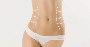 What You Need to Know About Liposuction in Abu Dhabi