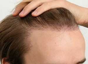 Expert Hair Transplantation Services in Abu Dhabi