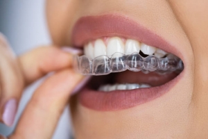 Invisalign- Always a Clear Choice for Orthodontic Treatment