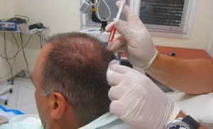 Restore Your Hair's Vitality with Plasma Injections in Abu Dhabi