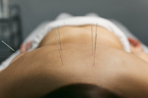 The Synergy of Acupuncture and Biomagnetic Therapy for Natural Health