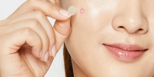 Ultimate Guide to Pimple Patches: An Effective Solution for Acne in Pakistan