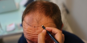 Navigating the Recovery Process: Hair Transplant Aftercare Tips