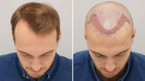 Discovering the Impact of Hair Transplantation on Mental Health in Abu Dhabi