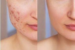 From Pimples to Perfection: The Ultimate Acne Treatment Plan