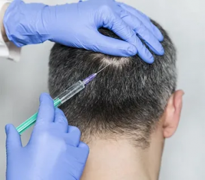 Unlocking the Potential of Plasma Injections for Hair in Abu Dhabi