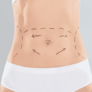 The Role of Technology in Modern Tummy Tuck Clinics