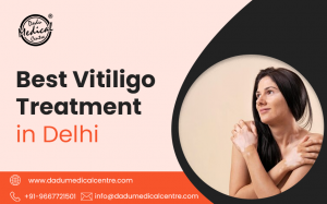 A Detailed Guide of Vitiligo & Its Related Elements