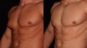 Why Gynecomastia Surgery in Dubai Is Popular Among Young Professionals