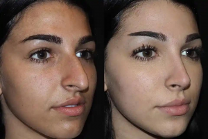 Rhinoplasty in Dubai: Transform Your Appearance with Precision Surgery