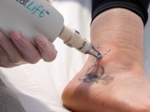 Smooth Your Skin Again with Laser Tattoo Removal