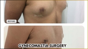 10 Amazing Benefits of Gynecomastia