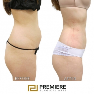 Why Should You Consider Liposuction Before And After BBL Surgery?