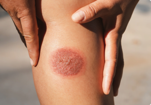 Burn Scars No More: How Plastic Surgery Can Change Your Life