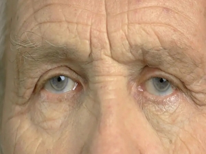 Cataract Surgery: Why second eye Cataract surgery is important?