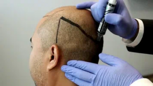 Receding Hairline Hair Transplant in Dubai Could Be the Answer